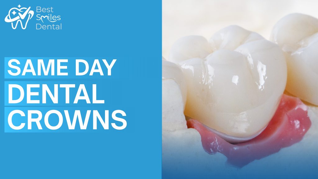 same day dental crowns