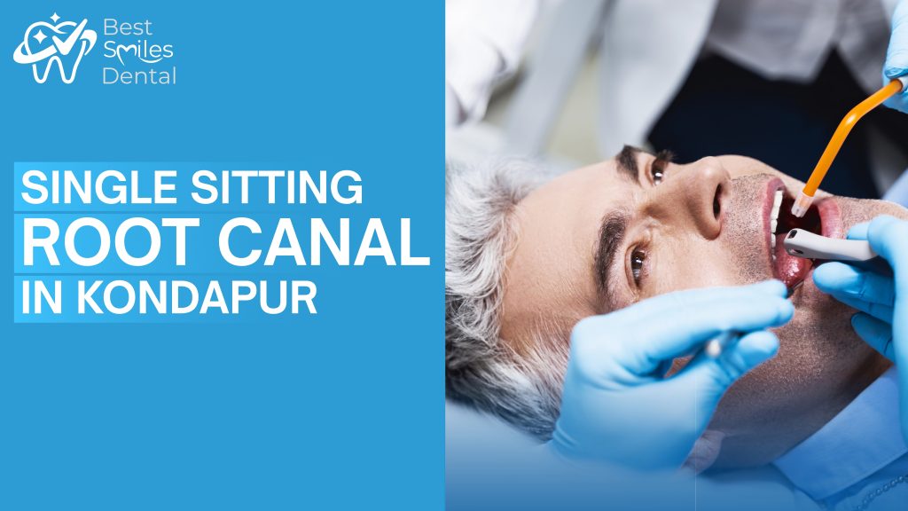 single sitting root canal treatment