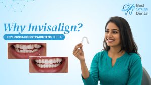 Invisalign in Hyderabad