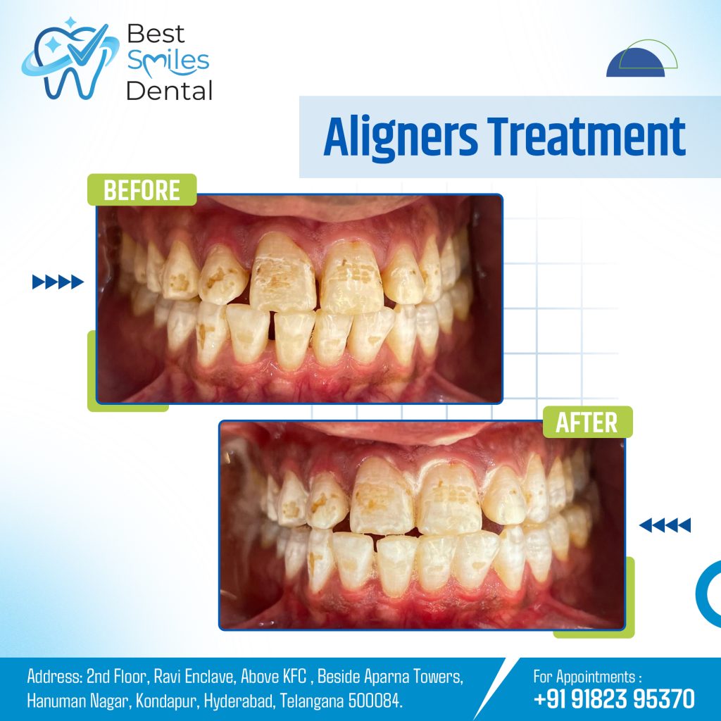 Invisalign Treatment in Hyderabad @ Best Smiles Dental | Before & After
