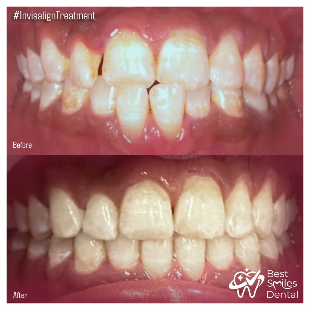 Invisalign treatment in Hyderabad