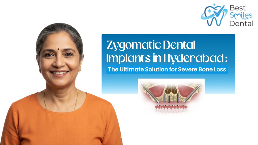 Zygomatic Dental Implants in Hyderabad