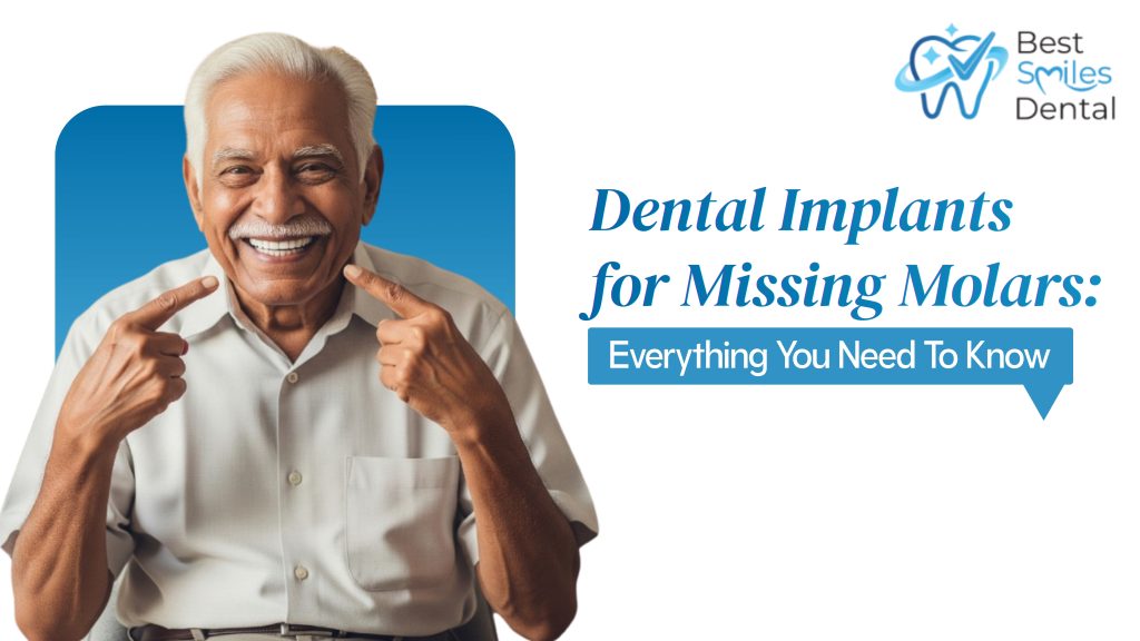 Dental Implants in Hyderabad for Missing Molars