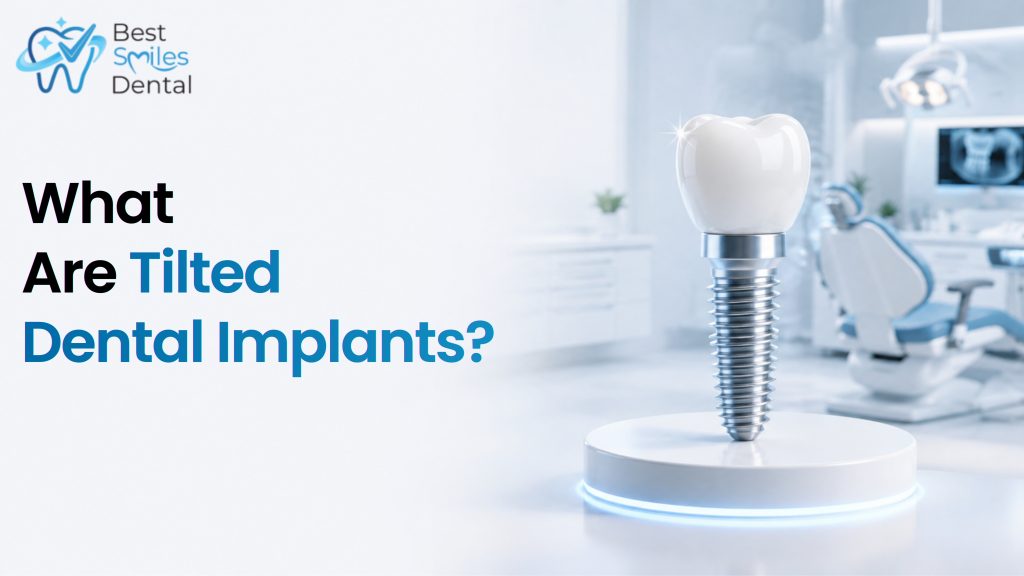tilted dental implants
